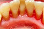 Inside of teeth following tartar removal