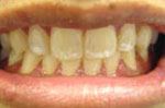 Discolored teeth before treatment