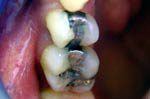 Two teeth with large amalgam fillings