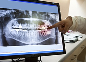 Panoramic dental x-rays on computer