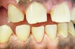 Closeup of smile following tooth and gum treatments