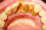 Inside of teeth with severe tartar buildup