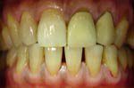 Yellow smile before treatment