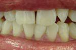 Closeup of repaired front teeth