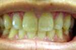 Whitened teeth following treamtent