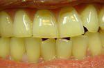 Yellow and discolored teeth