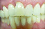 Damaged smile before treatment