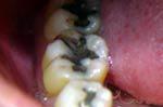 Closeup of teeth with metal fillings