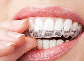 Woman placing Invisalign tray