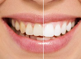 Smile split half before and half after teeth whitening