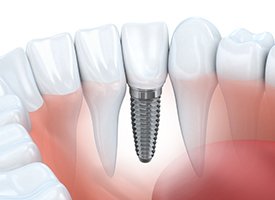 Implant supported dental crown animation