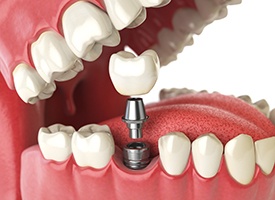 Animation of dental implant restoration