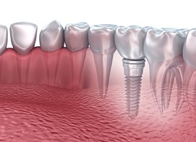 Animation of implant-retained restoration