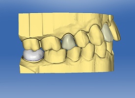 CEREC smile design