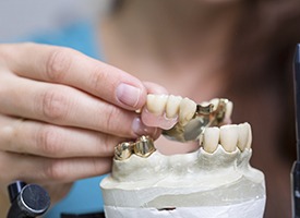 Model of teeth with partial denture