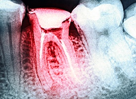 X-rays of root canal treated tooth